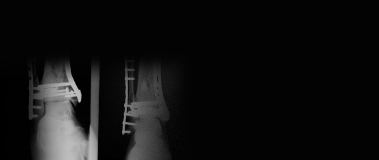 Knee injury